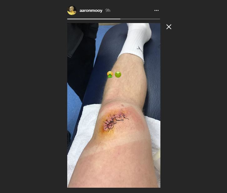Aaron Mooy's knee injury. IMAGE: Instagram